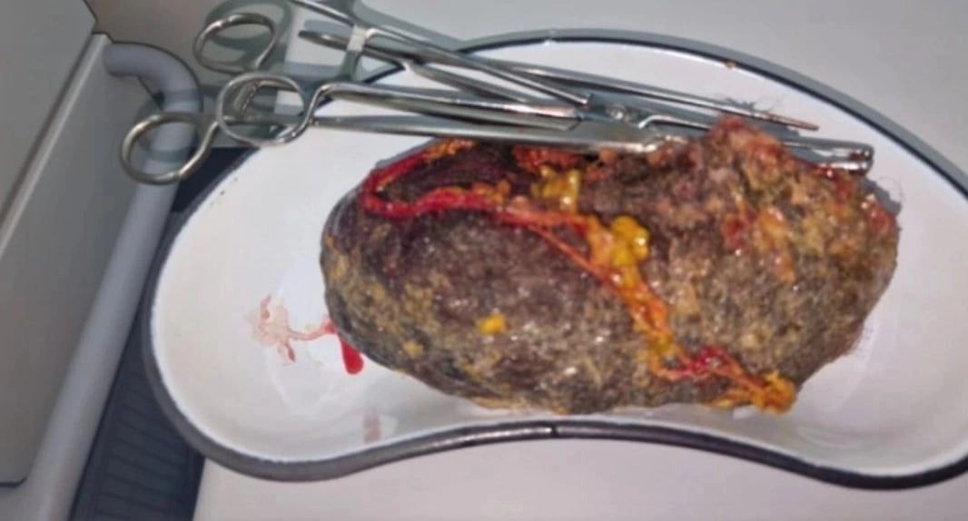 В Алматы хирурги извлекли из желудка 10-летнего ребенка 900 граммов ворса от ковра