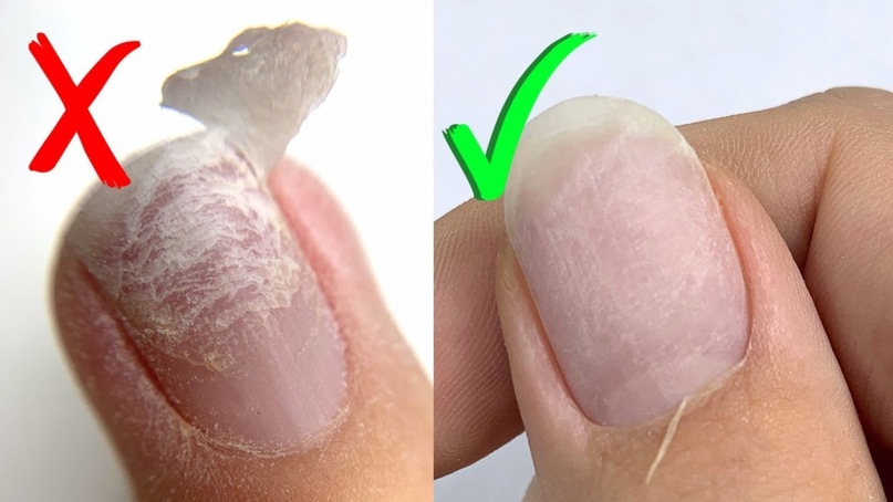 Дерматолог: самостоятельное избавление от гель-лака плохо влияет на ногти
