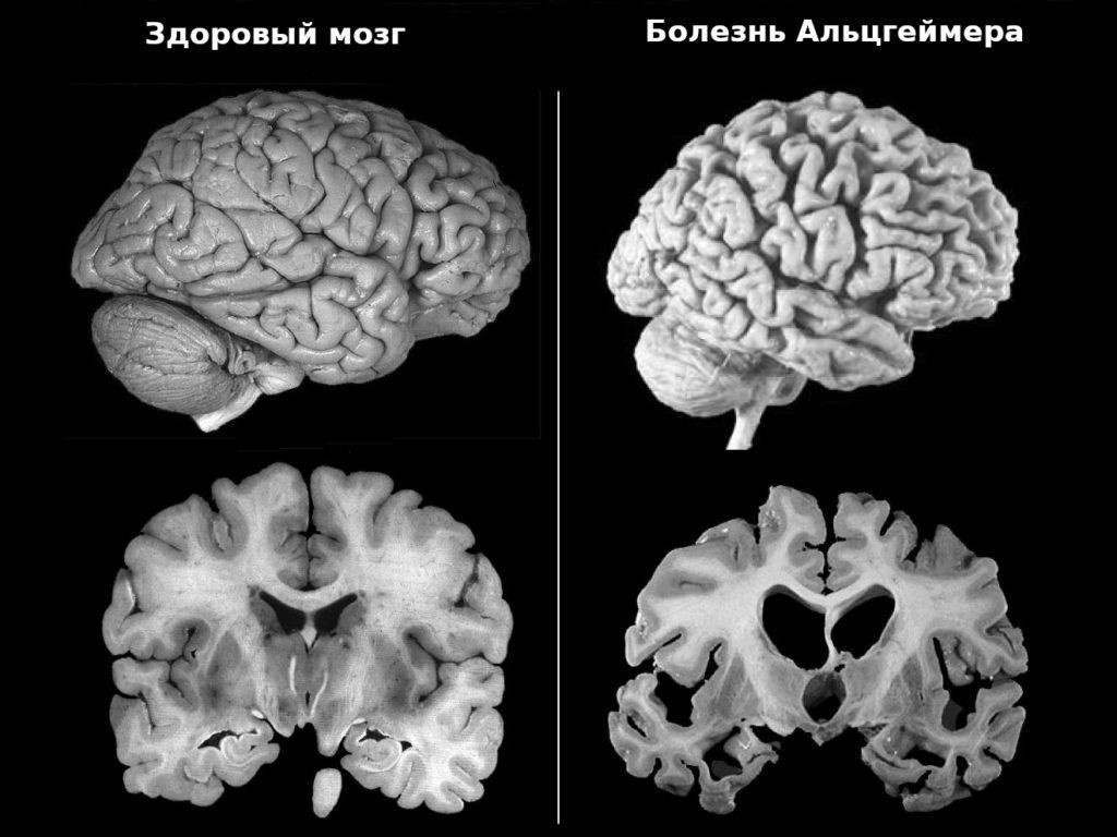 Mirror: учёные обозначили основную причину развития болезни Альцгеймера