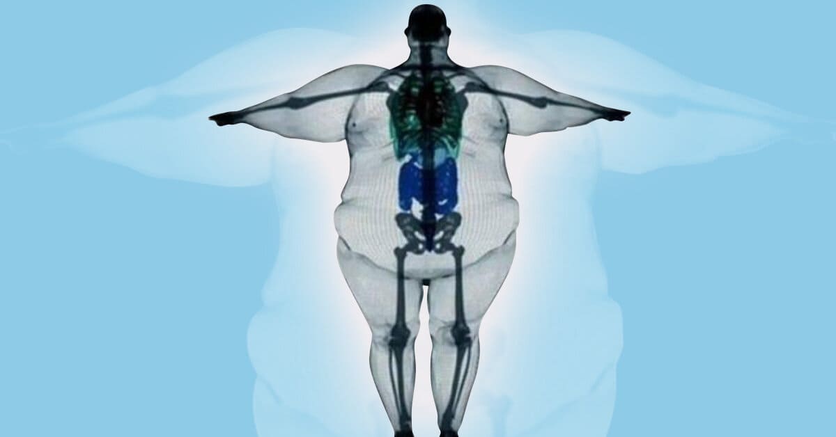 Диетолог: «широкая кость» не является фактором накопления лишнего веса