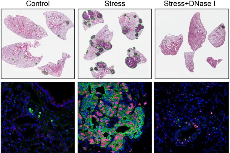 Ученые выяснили, как стресс провоцирует распространение рака