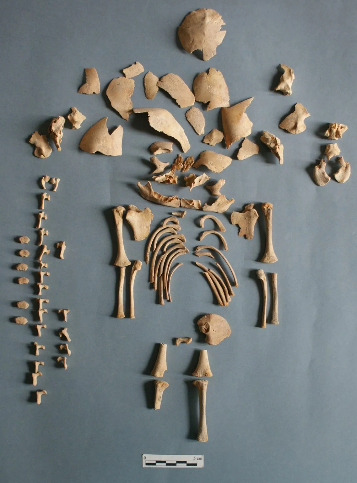 Древняя ДНК выявила первый случай синдрома Эдвардса у доисторических людей