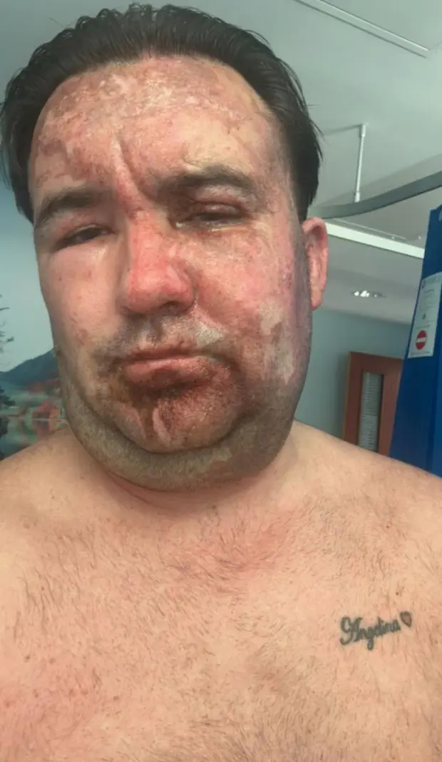 The Sun: в Великобритании две женщины напали на рабочего и облили его кислотой